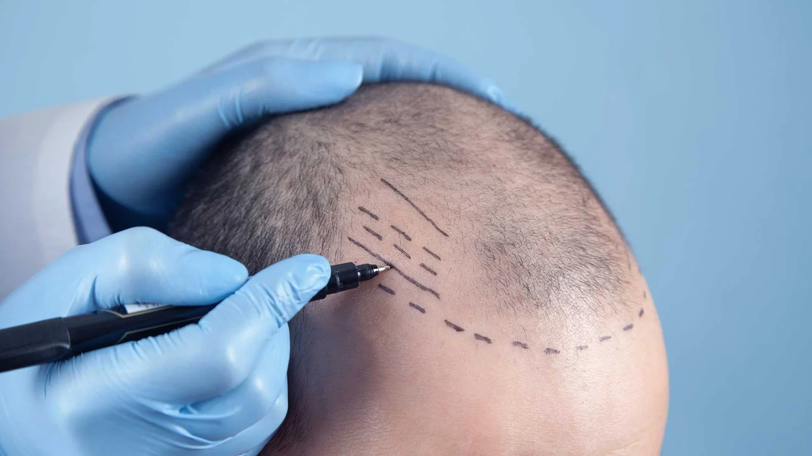 What Are FUT And FUE Methods? - Hair Transplantation in Turkey
