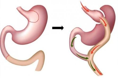 Obesity-Overweight Surgery Istanbul, Turkey