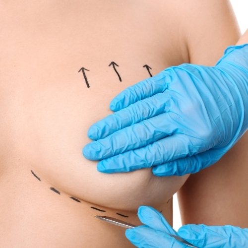 Breast Lift-Mastopexy Istanbul, Turkey
