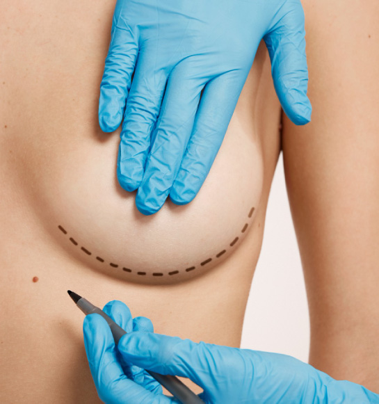Breast Lift