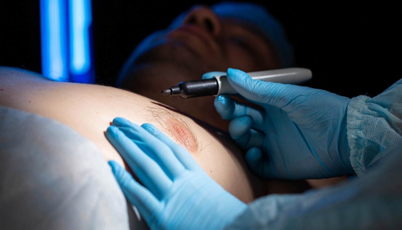 Gynecomastia-Man Boobs Surgery Turkey
