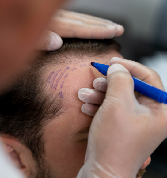 Hair Transplant Istanbul, Turkey