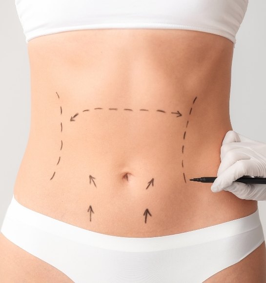 Liposuction
